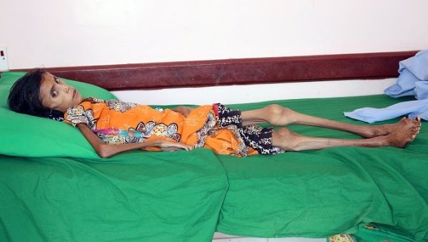 Malnourished Fatima Ibrahim Hadi, 12, who weighs just 10 kg lies on a bed at a clinic Aslam of the northwestern province of Hajjah, Yemen.
