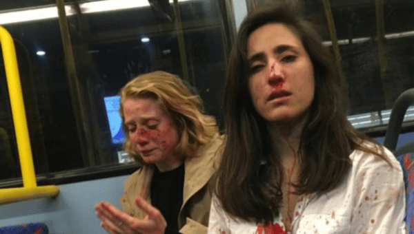 Chris, Dr. Melania Geymonat, after they were beaten by 4 men on a London bus May 30