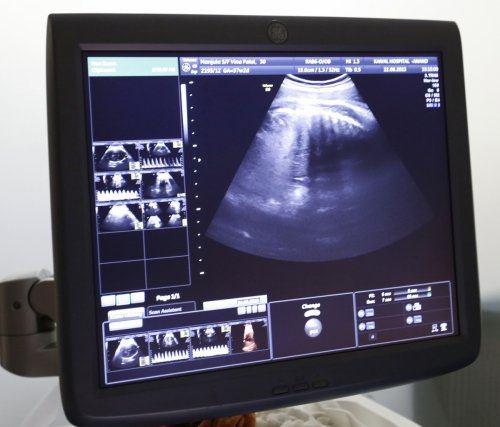 Currently 24 U.S. states require that an ultrasound be performed before performing an abortion procedure.