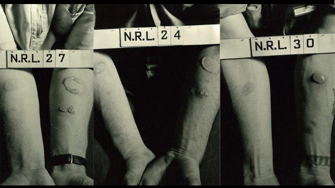 Images of the effects of mustard gas on soldiers' skin.