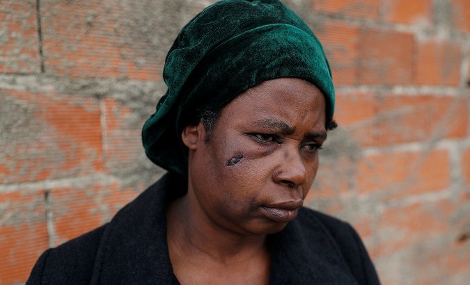 Julieta Joia Luvunga shows the wounds she says were caused by the police in the Jamaica neighborhood of Seixal, Portugal Jan. 22, 2019.