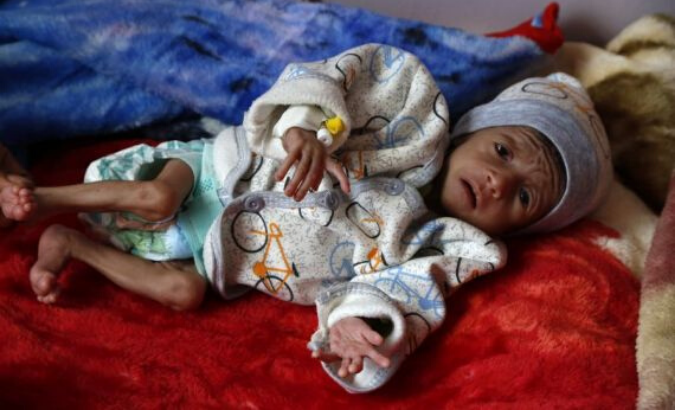 A malnourished child lies on the bed as he receives medical treatment at an anti-malnutrition ward in Al-Sabeen hospital in Sanaa, Yemen, Jan. 6, 2020.