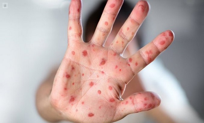 The Director of Health Surveillance, Dr. Guillermo Sequera, appealed to the population not to postpone medical consultation when rashes appear. Oct. 28, 2022.