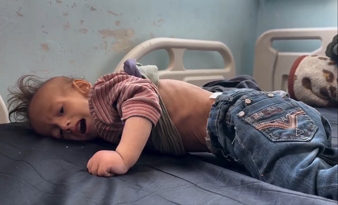 Malnourished Palestinian child in a medical center in Gaza, March 2024.
