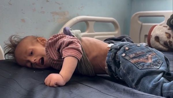 Malnourished Palestinian child in a medical center in Gaza, March 2024.